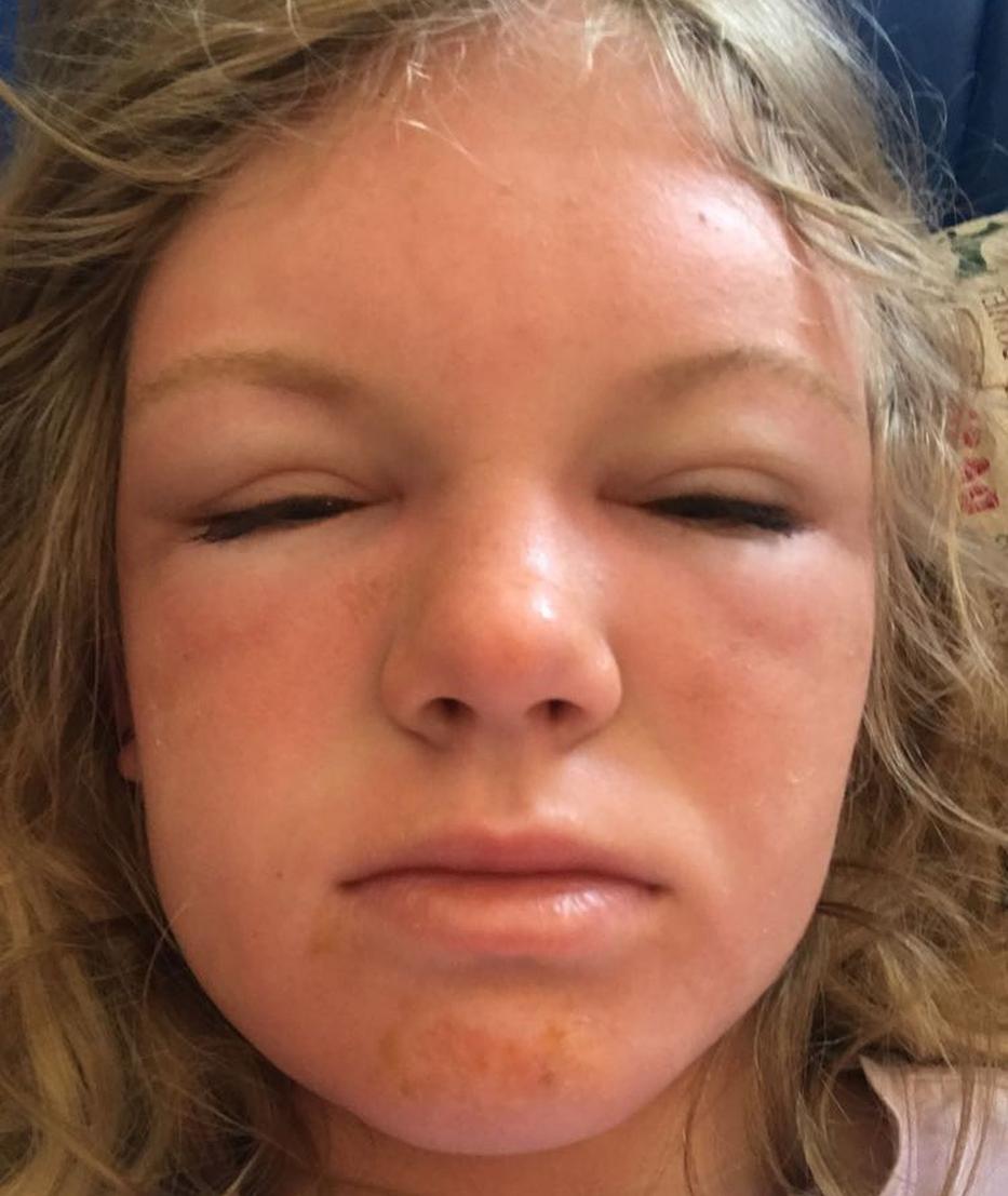 Das Gesicht des jungen Mädchens war bis zur Unkenntlichkeit geschwollen – Foto: Northfoto